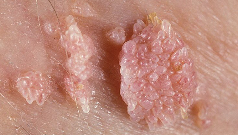 HPV_kondilomata