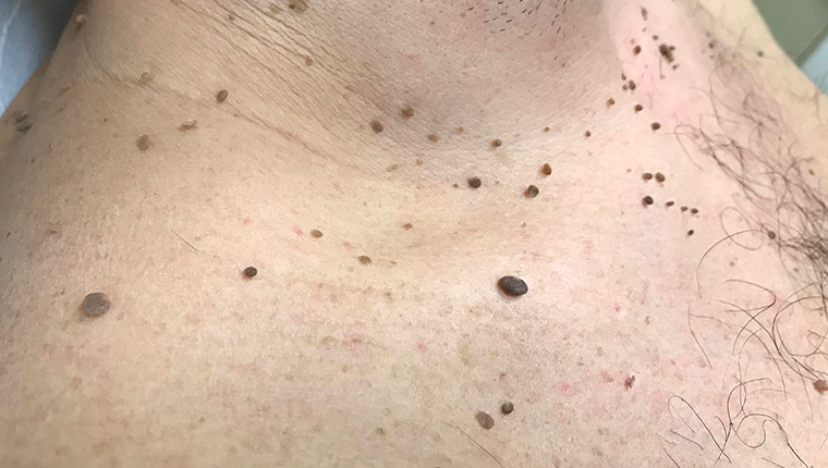 papillomas on the skin