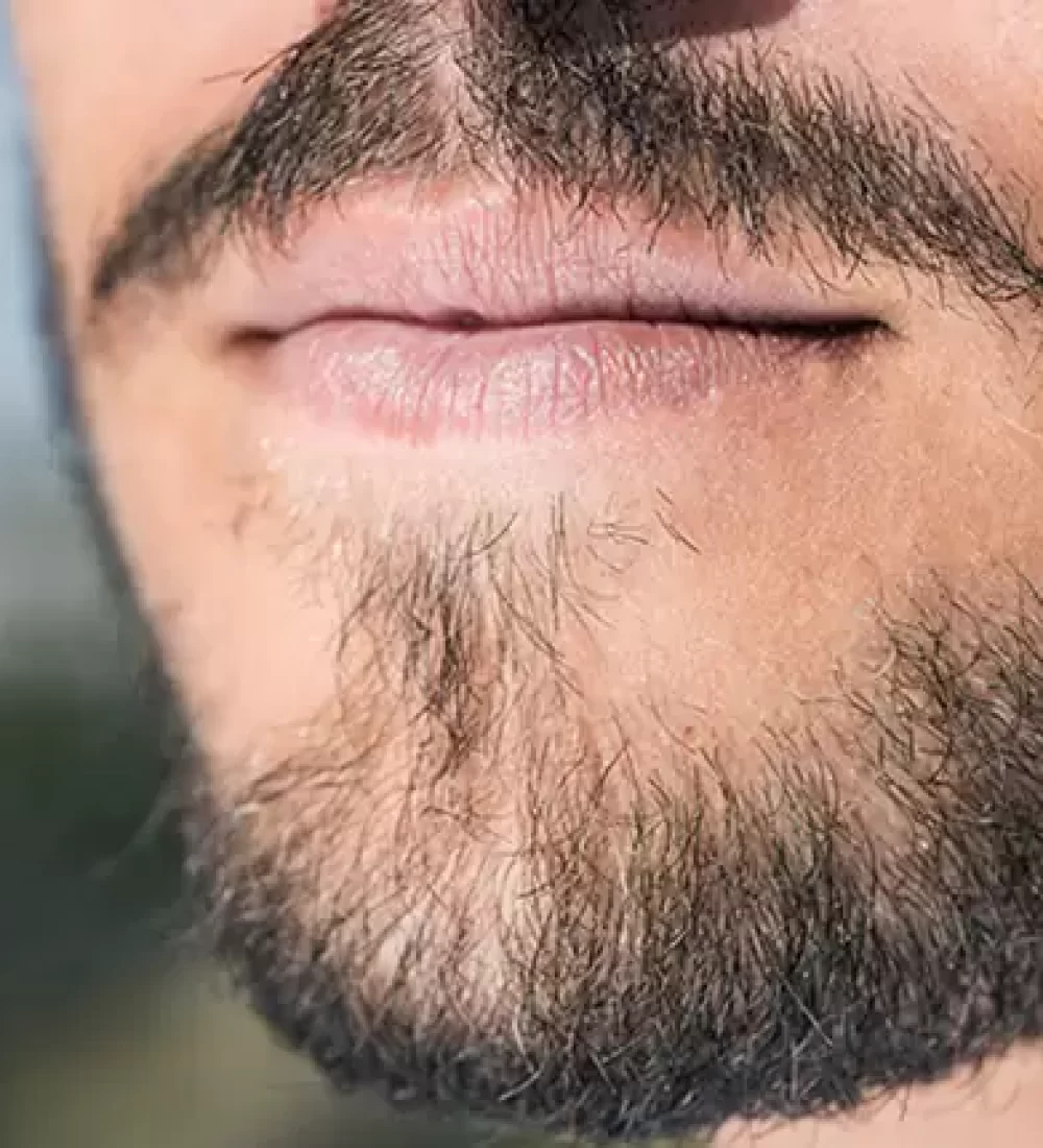 beard-transplant.jpg